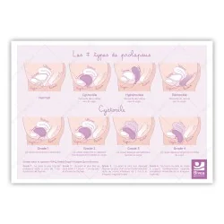 schéma recto des prolapsus : cystocèle, hystérocèle, rectocèle sur fond blanc