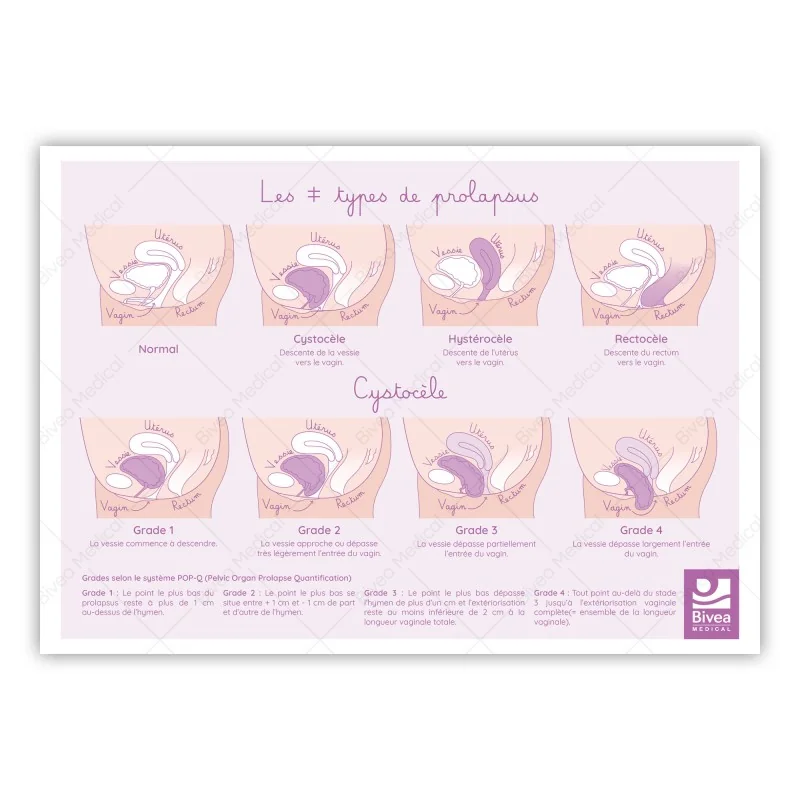 schéma recto des prolapsus : cystocèle, hystérocèle, rectocèle sur fond blanc