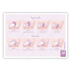 schéma verso des prolapsus : cystocèle, hystérocèle, rectocèle sur fond blanc