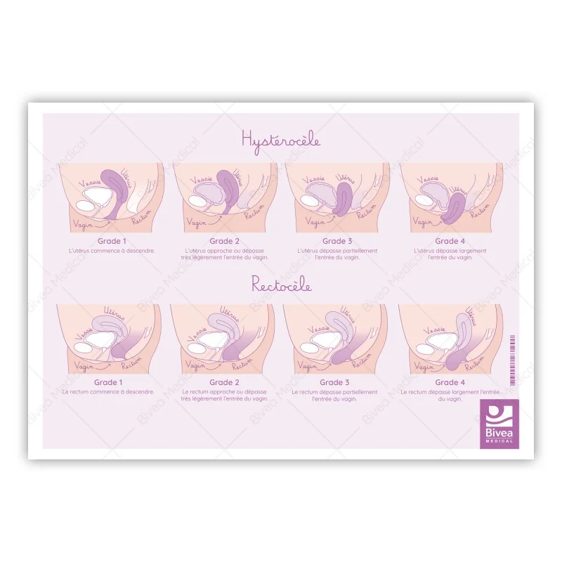 schéma verso des prolapsus : cystocèle, hystérocèle, rectocèle sur fond blanc
