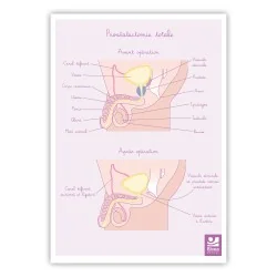 Schéma Prostatectomie totale