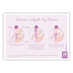 Schéma d'un sphincter artificiel chez l'homme sur fond blanc