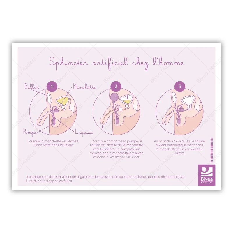 Schéma d'un sphincter artificiel chez l'homme sur fond blanc