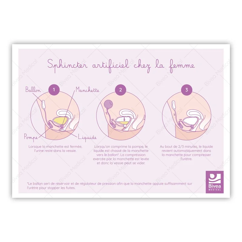 Schéma d'un sphincter artificiel chez la femme sur fond blanc
