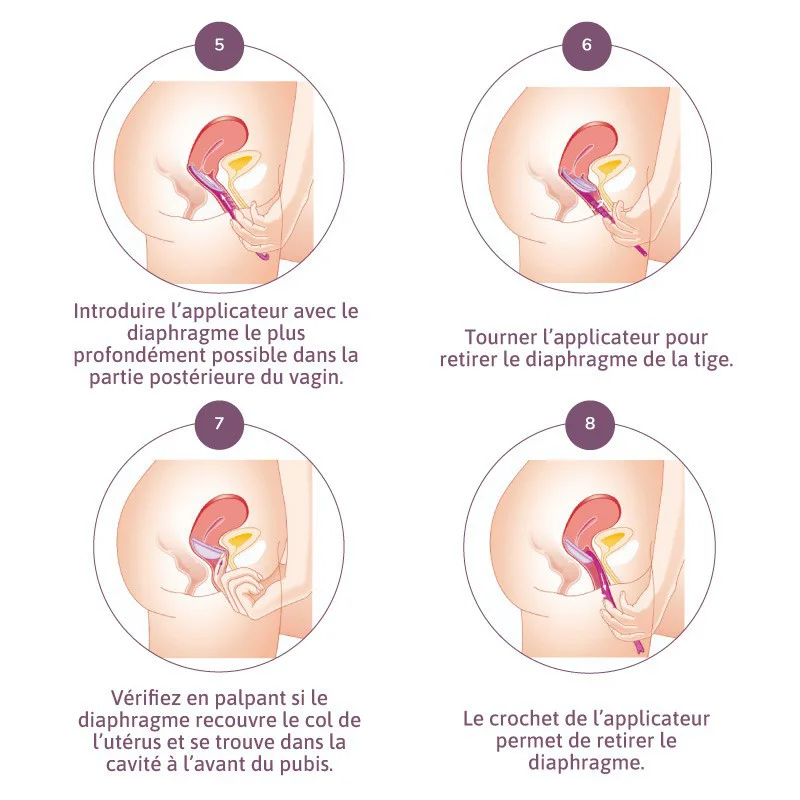 Comment insérer le diaphragme contraceptif avec l'applicateur