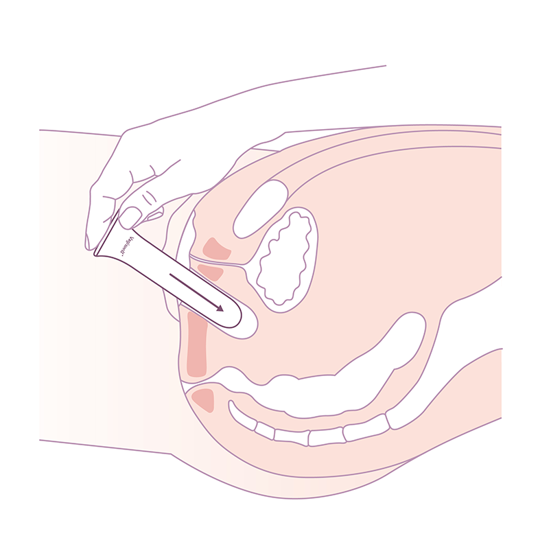 schéma dilatateur vaginoplastie