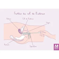 schéma anatomique du frottis du col de l'utérus