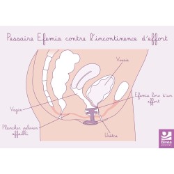 carte anatomique utilisation pessaire Efemia