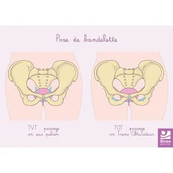 Carte anatomique Pose de bandelette