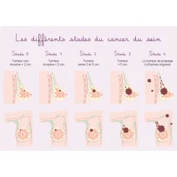 Carte différents stades du cancer du sein et schémas détaillés du sein