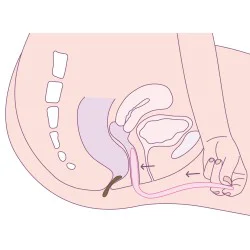 Dispositif pour rectocèle Femmeze