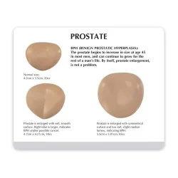 Schéma légendé des stades d'hypertrophie de la prostate