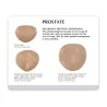 Schéma légendé des stades d'hypertrophie de la prostate Schéma légendé des stades d'hypertrophie de la prostate
