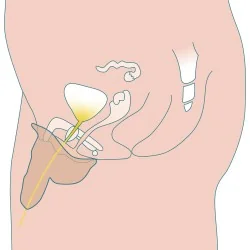 Stand to Pee packer 2 - circoncis