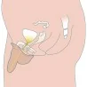Stand to Pee packer 2 - circoncis