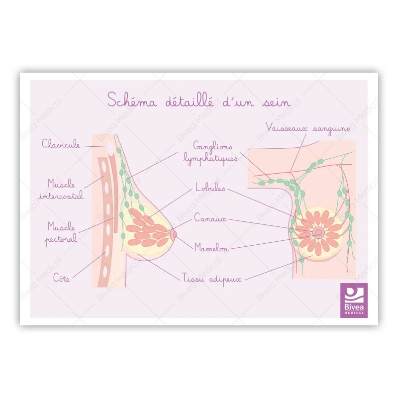Carte différents stades du cancer du sein et schémas détaillés du sein Carte différents stades du cancer du sein et schémas détaillés du sein