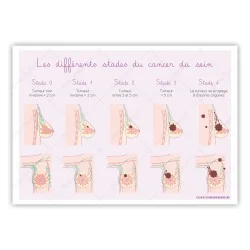Carte différents stades du cancer du sein et schémas détaillés du sein
