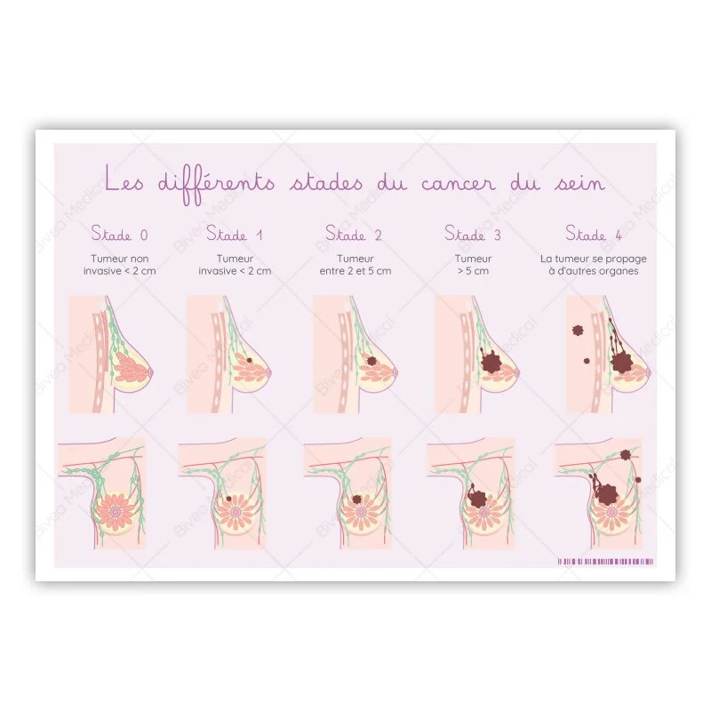 Carte différents stades du cancer du sein et schémas détaillés du sein Carte différents stades du cancer du sein et schémas détaillés du sein