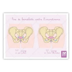 Carte anatomique Pose de...