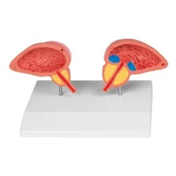 Modèle de prostate, 2 parties