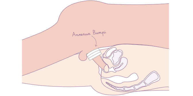 Anneau de constriction à boucle - Bivea Médical Taille T1-9 mm