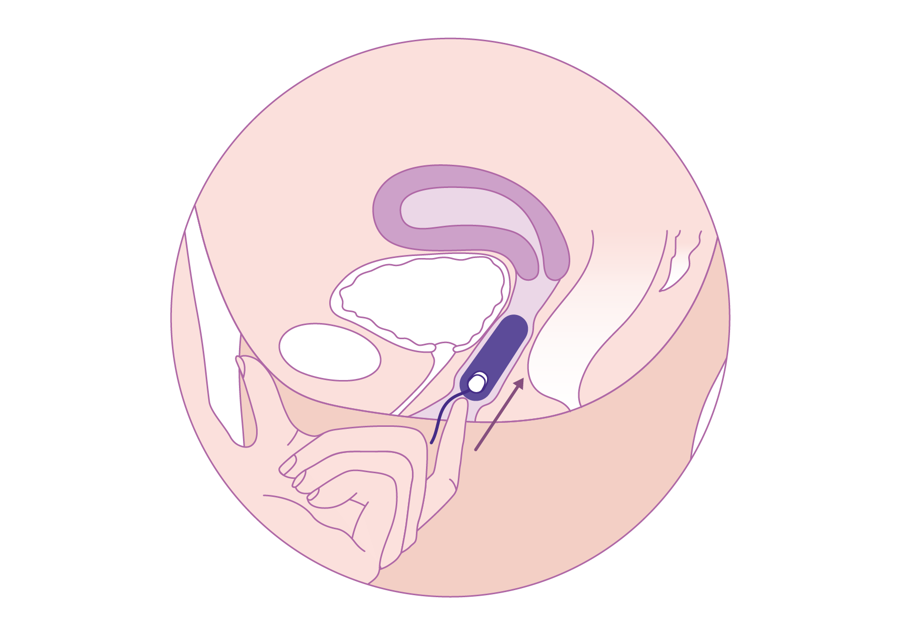 Trackle 2 - placement.png